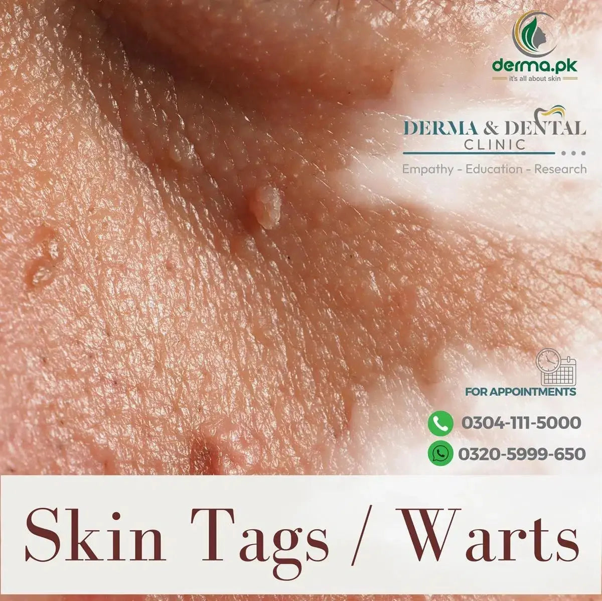 Advanced Dermatology Solutions: Expert Skin Tag and Wart Treatments