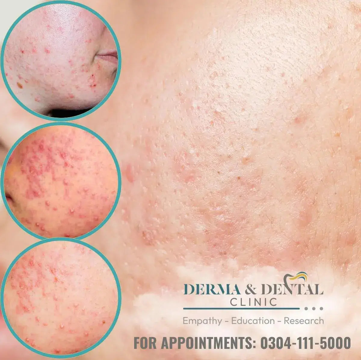 Conquer Nodulocystic Acne with Derma & Dental Clinic: Your Path to Clear, Healthy Skin