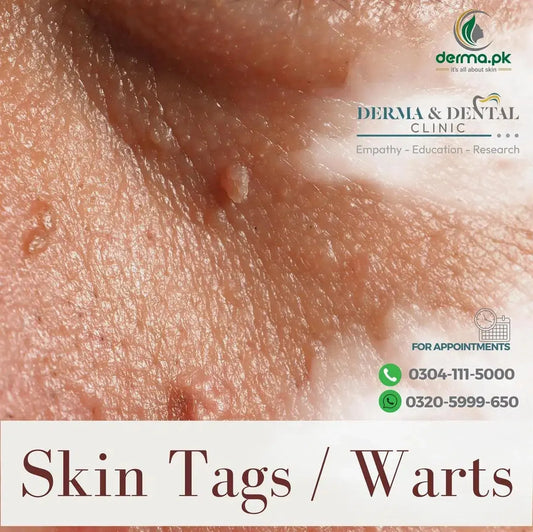 Advanced Dermatology Solutions: Expert Skin Tag and Wart Treatments