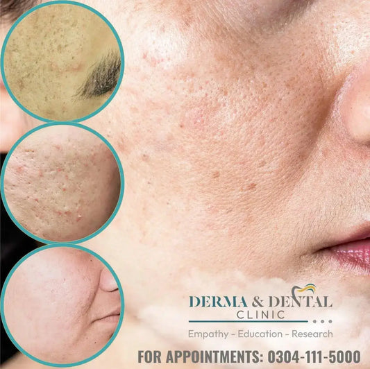 Erase Acne Scars and Unveil Your Radiant Skin: Derma & Dental Clinic's Expert Solutions