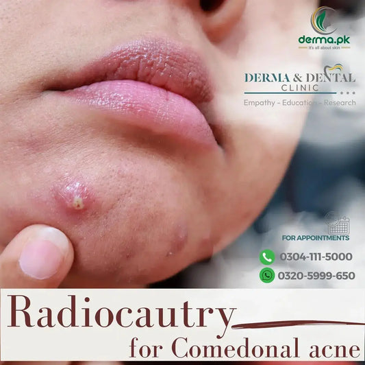 Radiocautry for Comedonal Acne: Advanced Dermatological Treatment at Derma & Dental Clinic