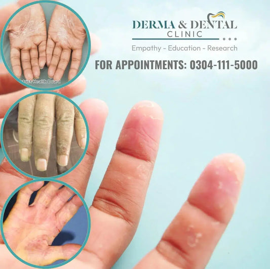 Understanding Pompholyx: Treatment and Relief at Derma & Dental Clinic